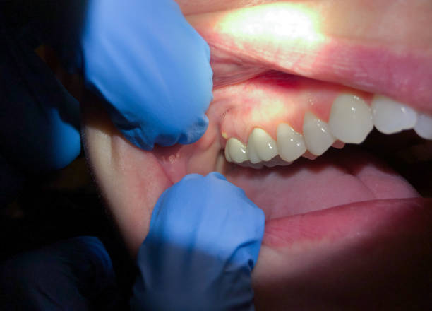 Best Dental Abscess Treatment in Kalifornsky, AK
